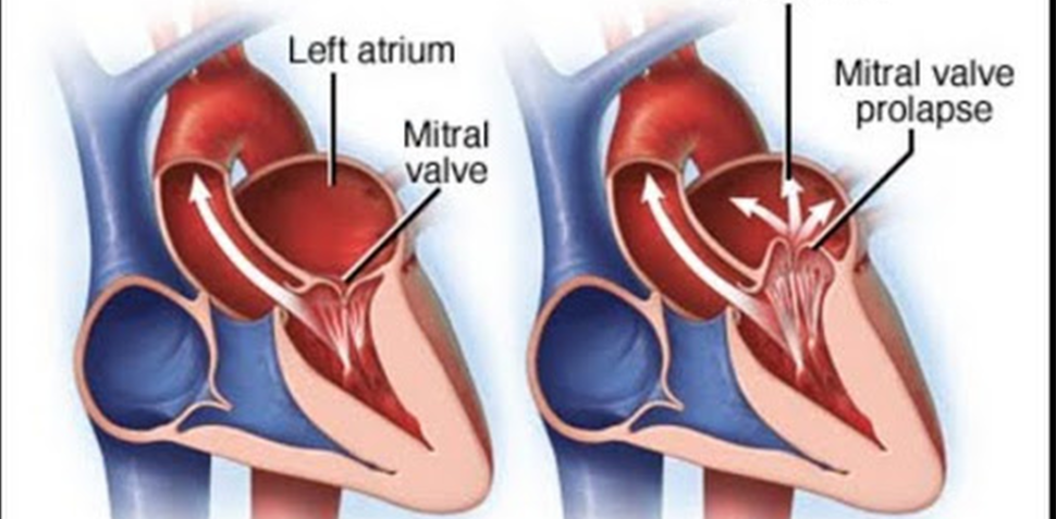 What Is Mitral Valve Regurgitation – Symptoms, Causes, And TreatmentTreatment