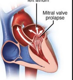 What Is Mitral Valve Regurgitation – Symptoms, Causes, And Treatment.