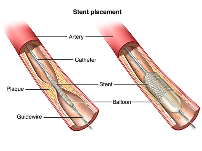 Angioplasty with stenting