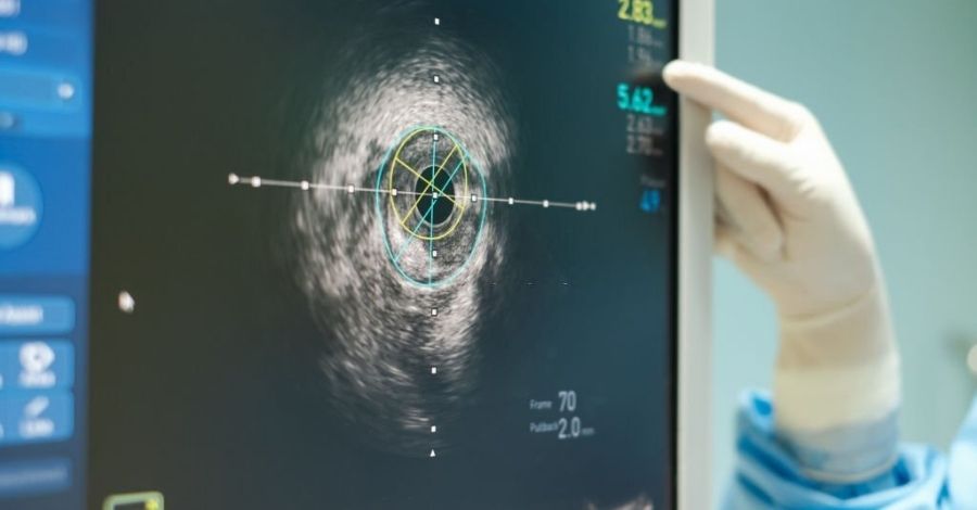 Coronary Angiography, When To Do Coronary Angiography, Coronary Angiography Process